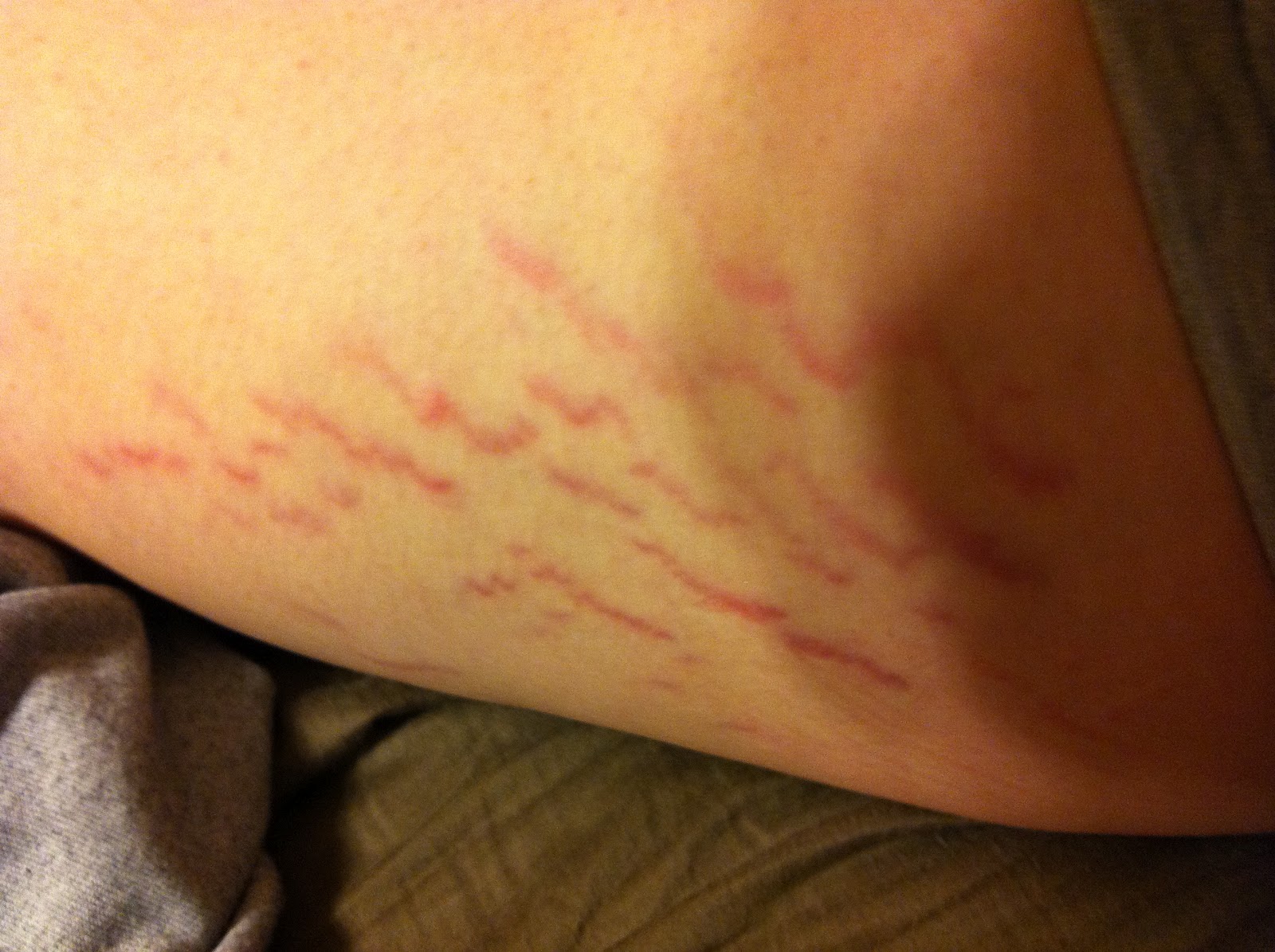 bartonella rash 1.JPG
