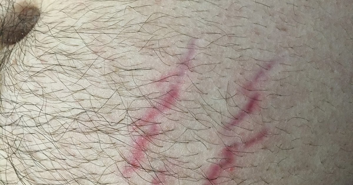bartonella rash 2.jpg