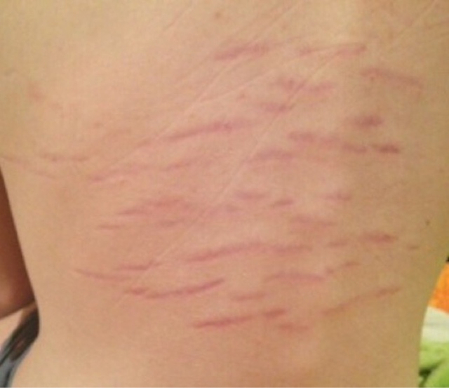 bartonella rash 3.jpg