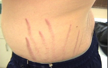 bartonella rash 4.jpg