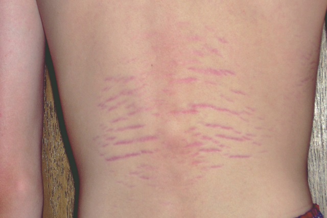 bartonella rash 5.jpg